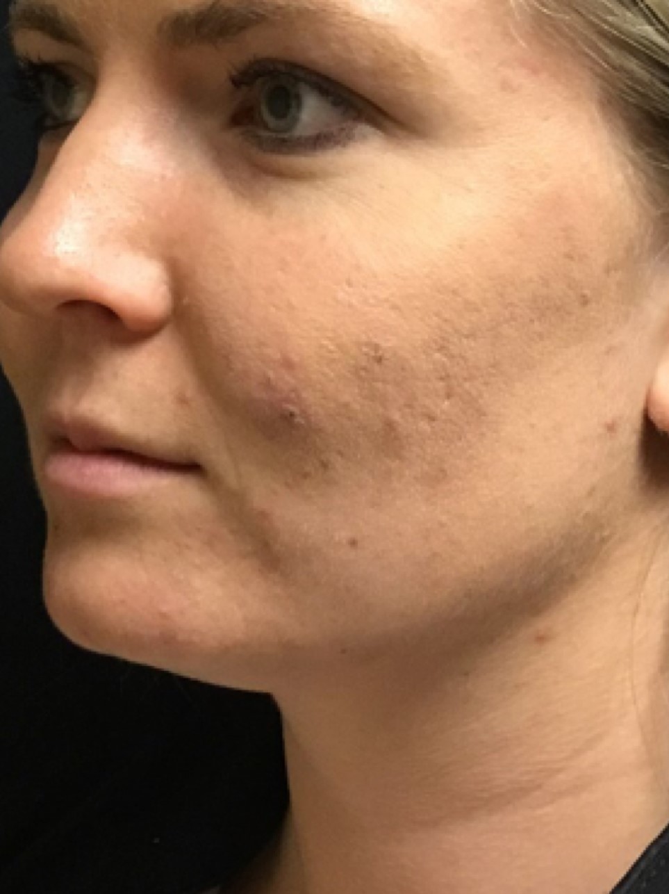 Patient #80222-2: Microneedling for Acne Scarring Before Image