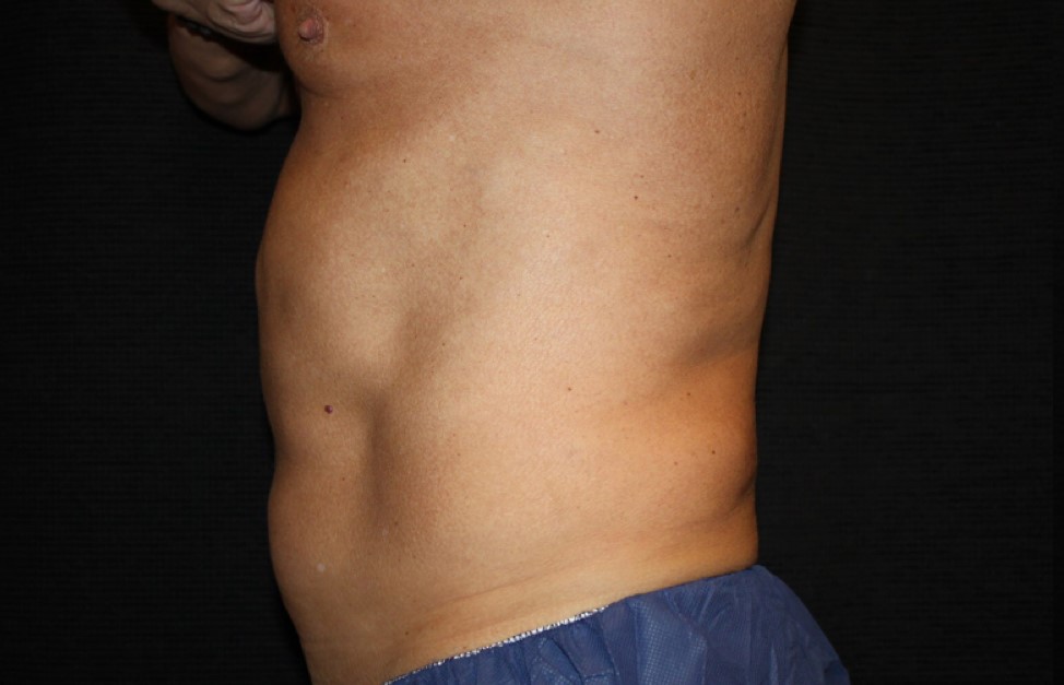 Patient #65350: CoolSculpting Before Image