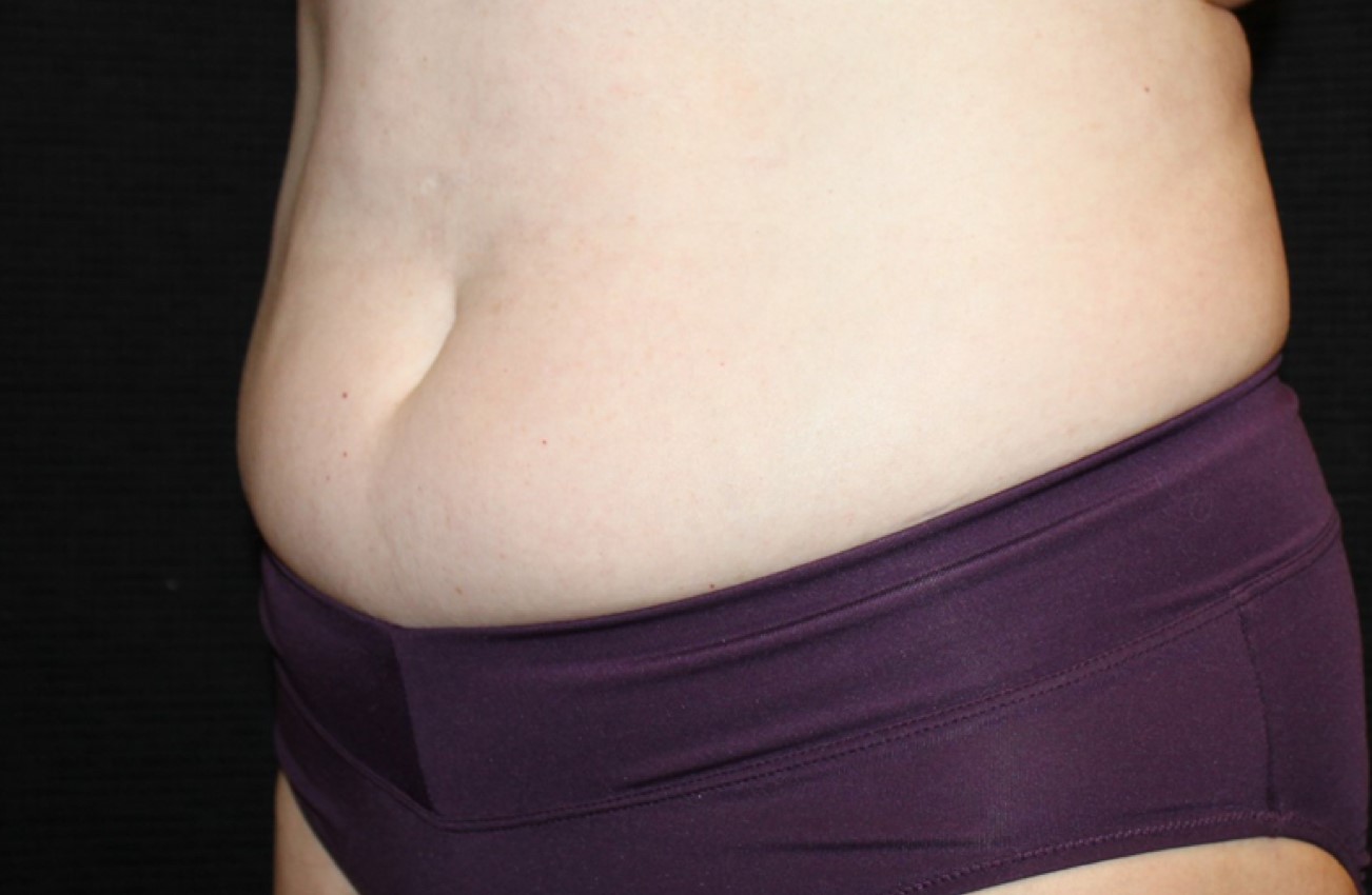Patient #58820: CoolSculpting Before Image