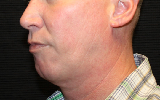 Patient #32637: FaceTite Before Image