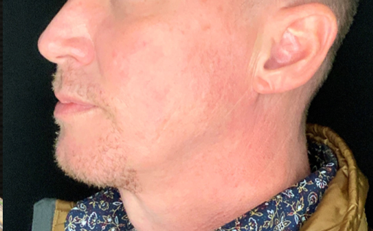 Patient #32637: FaceTite After Image