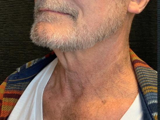 Patient #38694: In-Office Necklift Before Image