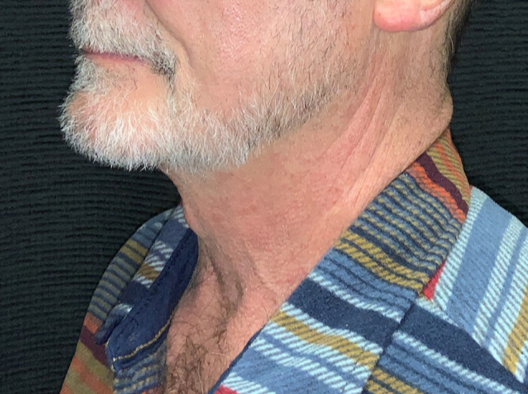 Patient #38694: In-Office Necklift After Image
