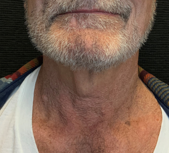 Patient #38694: In-Office Necklift Before Image
