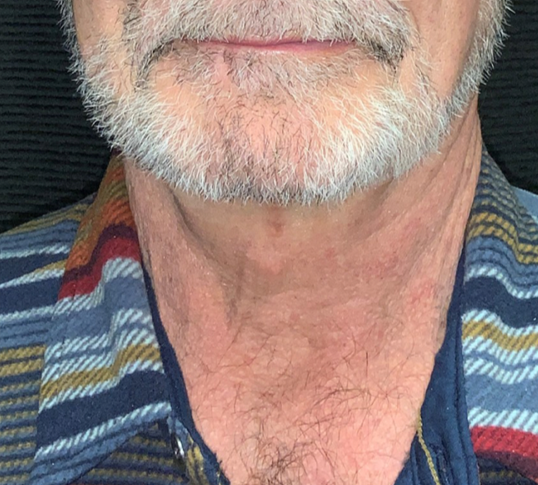 Patient #38694: In-Office Necklift After Image