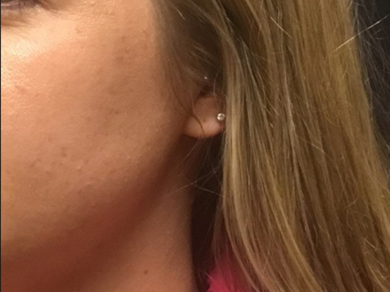 Patient #39130: Chemical Peel After Image