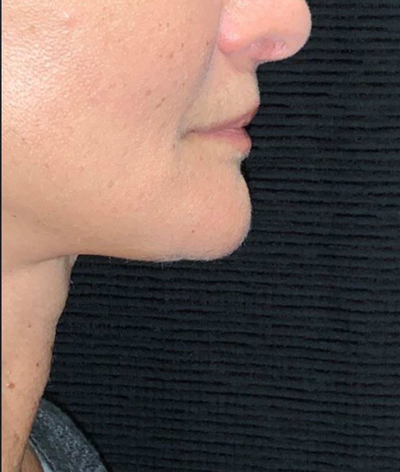 Patient #49658: Kybella After Image