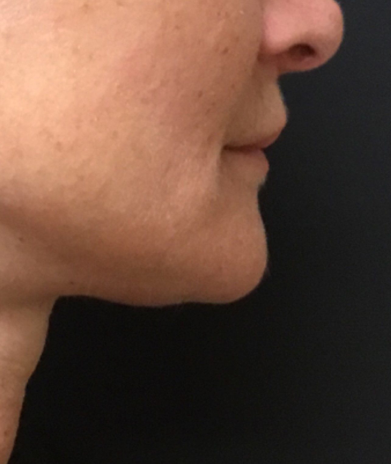 Patient #49658: Kybella Before Image