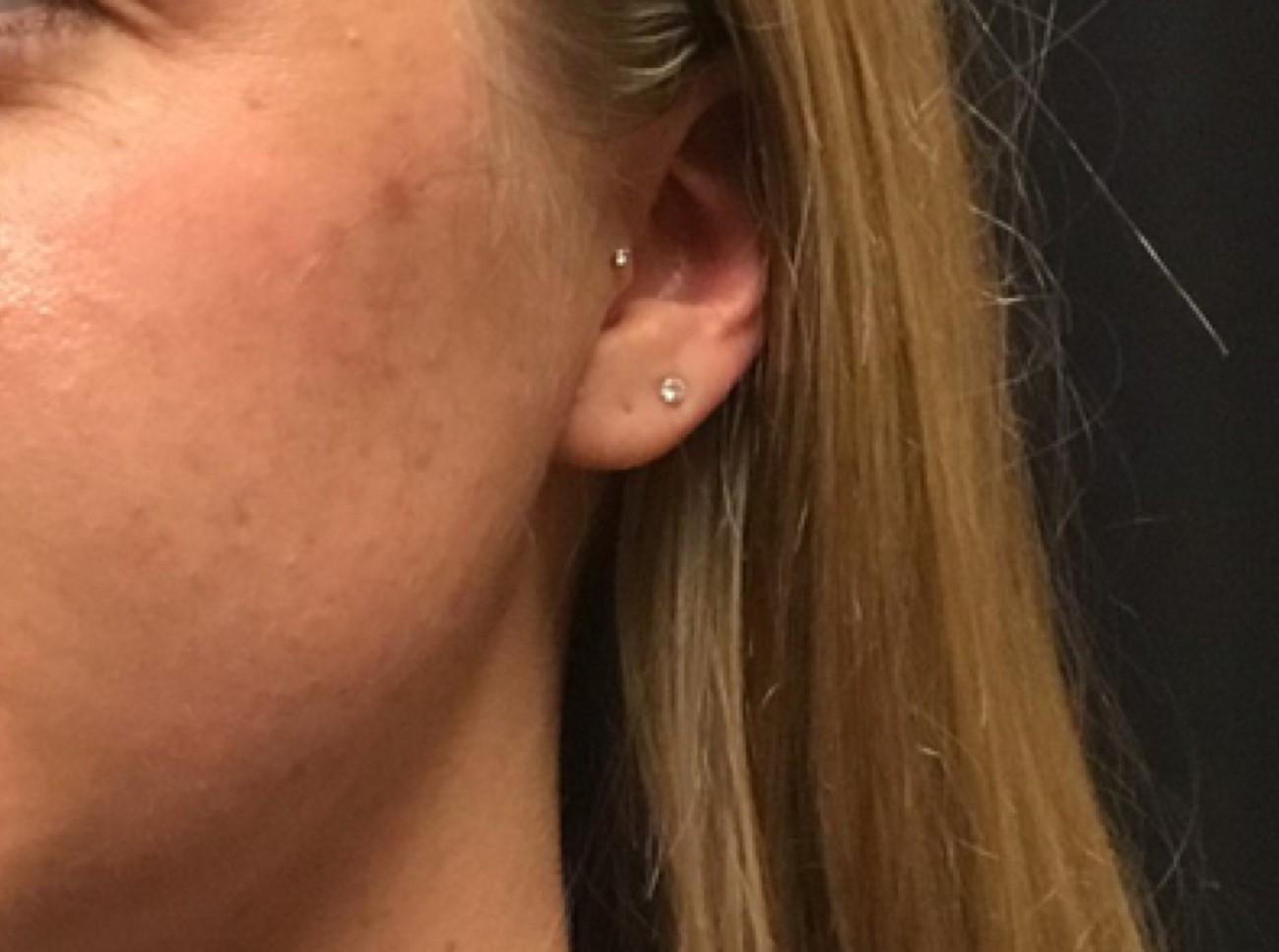 Patient #39130: Chemical Peel Before Image