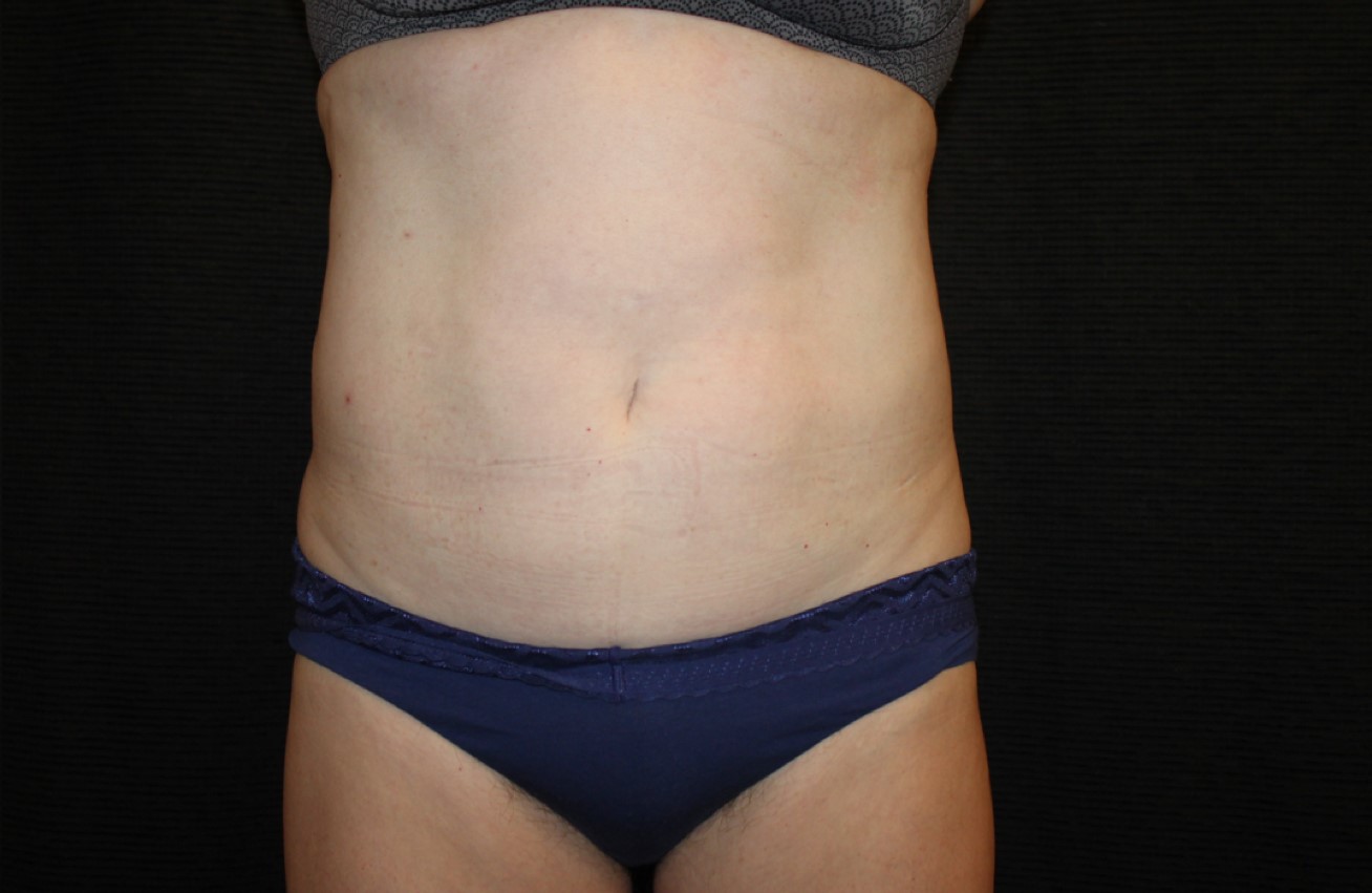 Patient #58820: CoolSculpting After Image