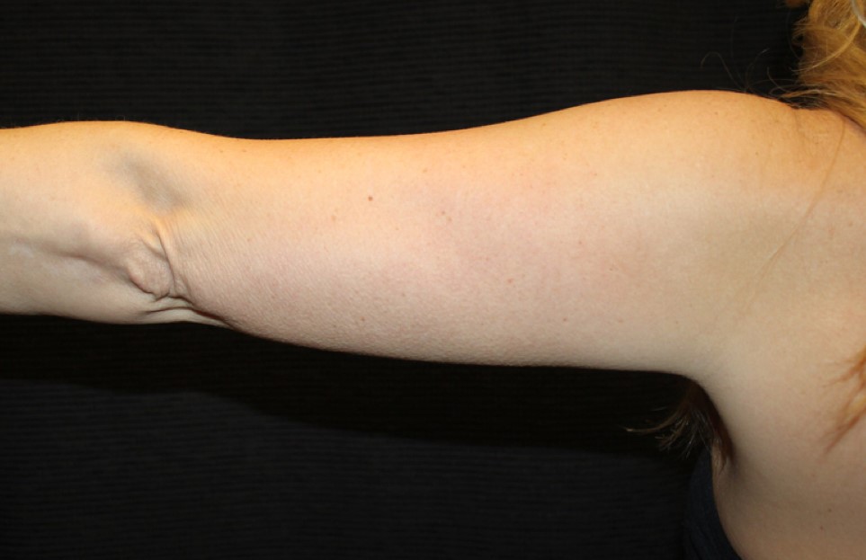 Patient #95479: CoolSculpting After Image