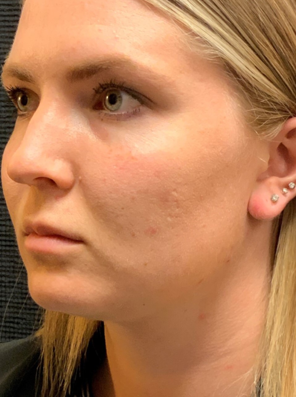 Patient #80222-2: Microneedling for Acne Scarring After Image