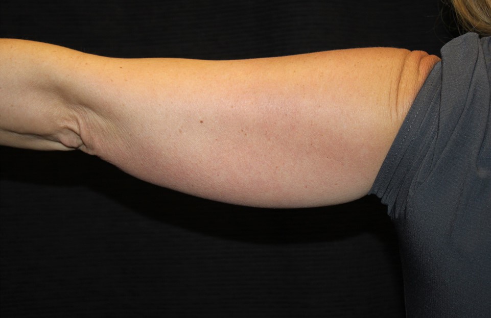 Patient #95479: CoolSculpting Before Image