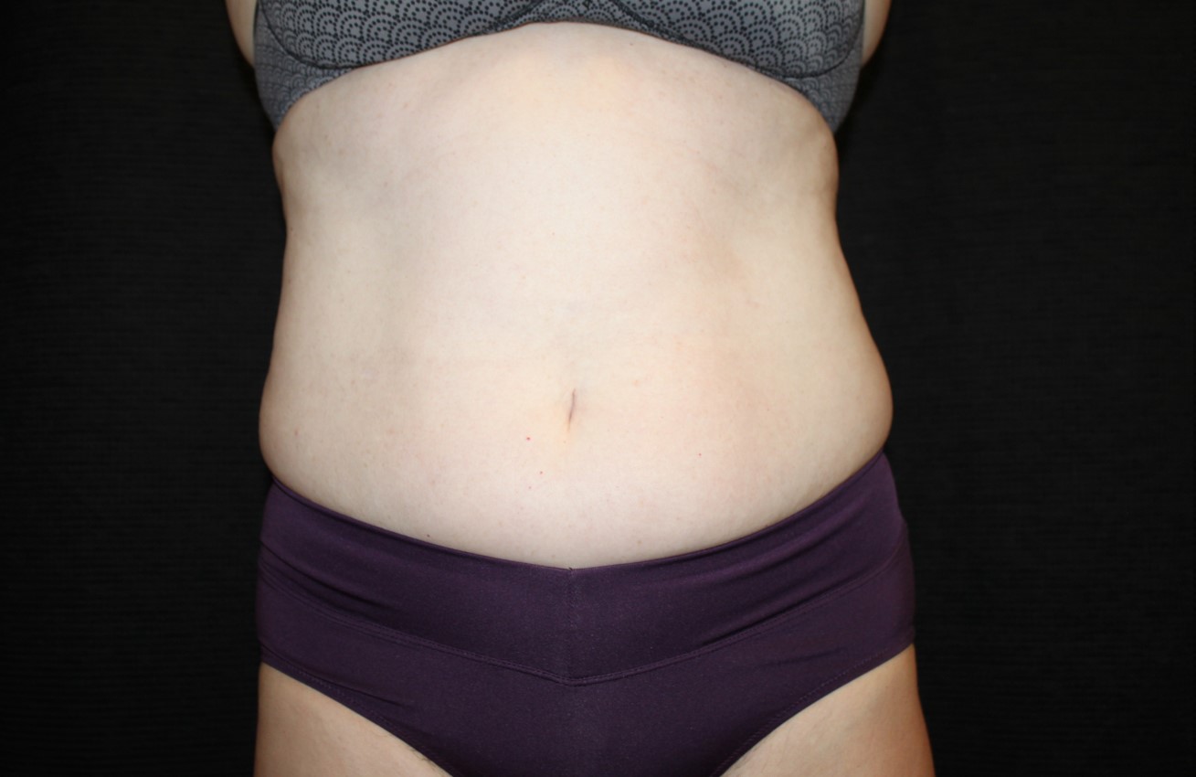 Patient #58820: CoolSculpting Before Image