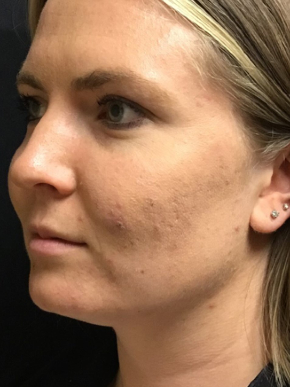 Patient #80222-2: Microneedling for Acne Scarring Before Image