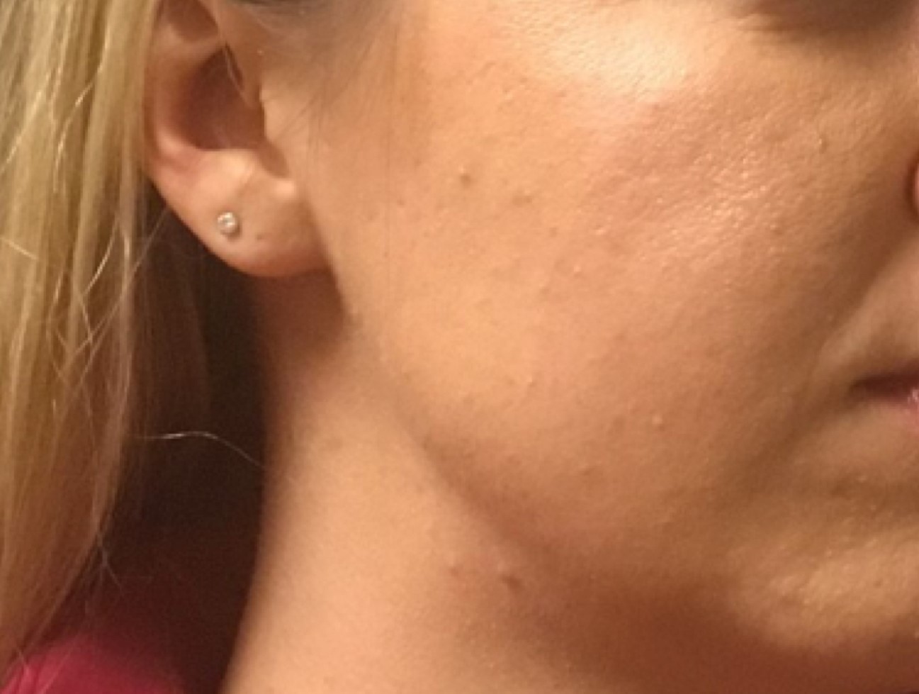 Patient #39130: Chemical Peel After Image