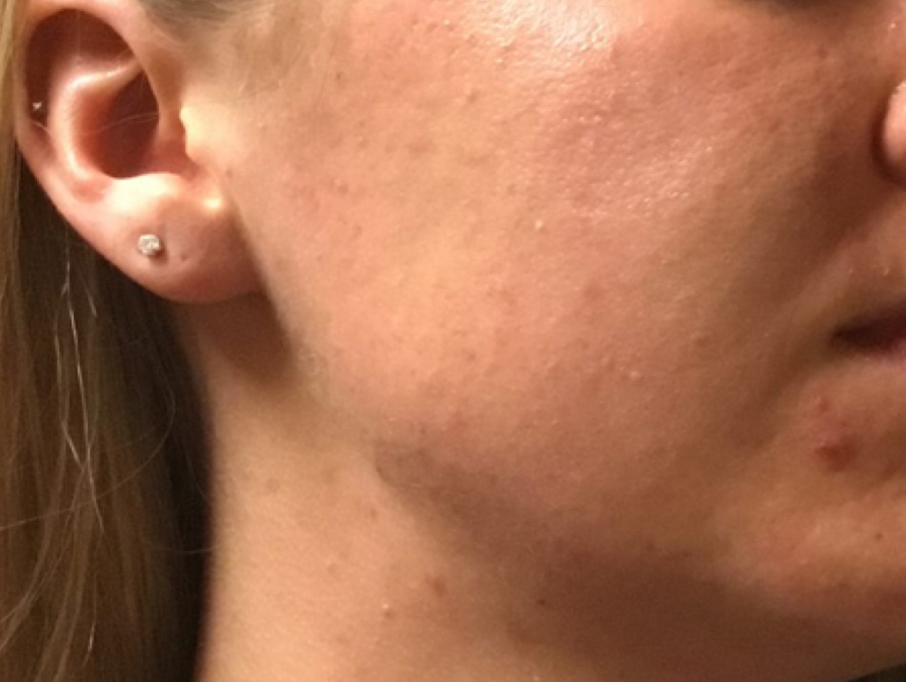 Patient #39130: Chemical Peel Before Image
