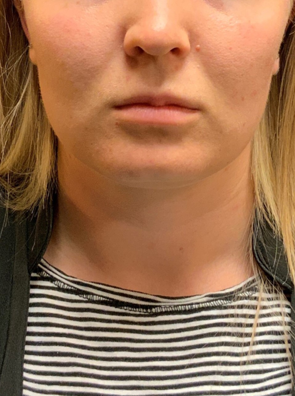 Patient #80222-2: Microneedling for Acne Scarring After Image