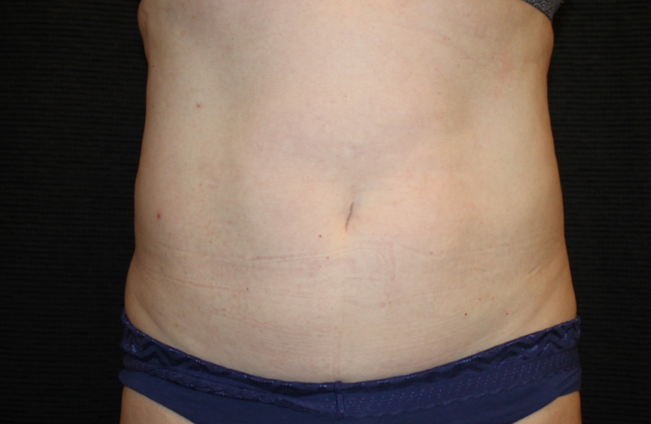 Patient #58820: CoolSculpting After Image