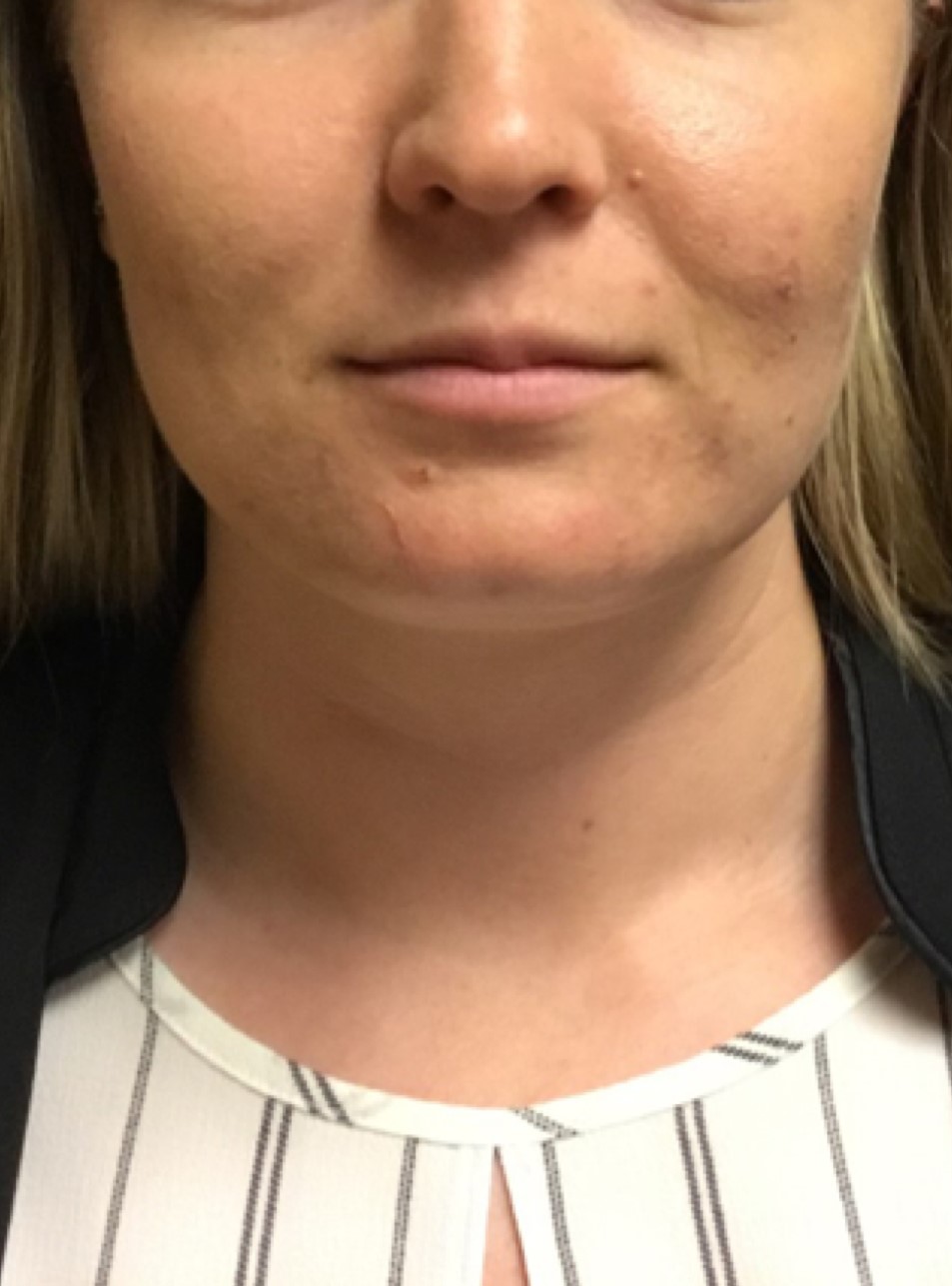 Patient #80222-2: Microneedling for Acne Scarring Before Image