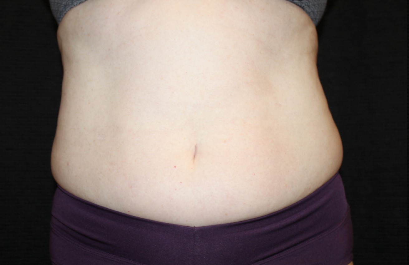 Patient #58820: CoolSculpting Before Image