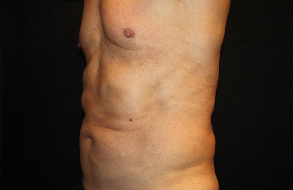 Patient #65350: CoolSculpting After Image