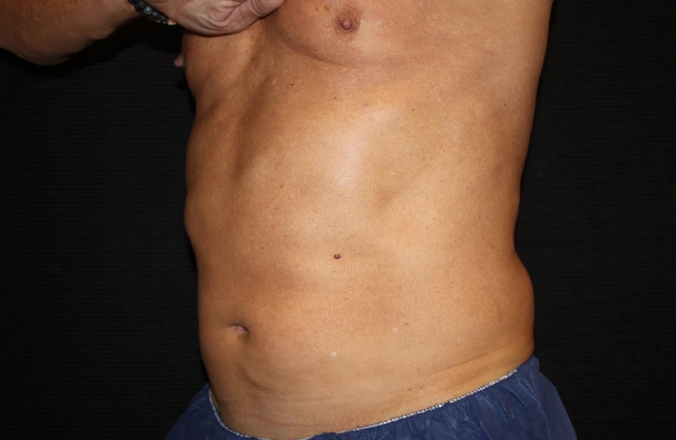 Patient #65350: CoolSculpting Before Image