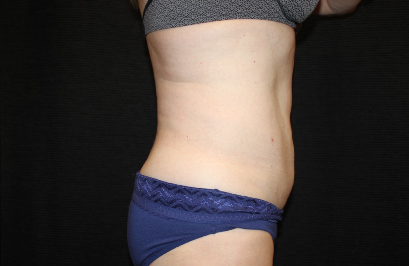 Patient #58820: CoolSculpting After Image
