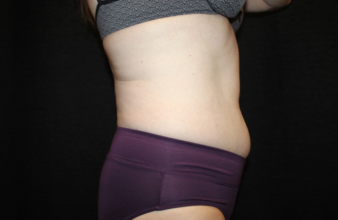 Patient #58820: CoolSculpting Before Image