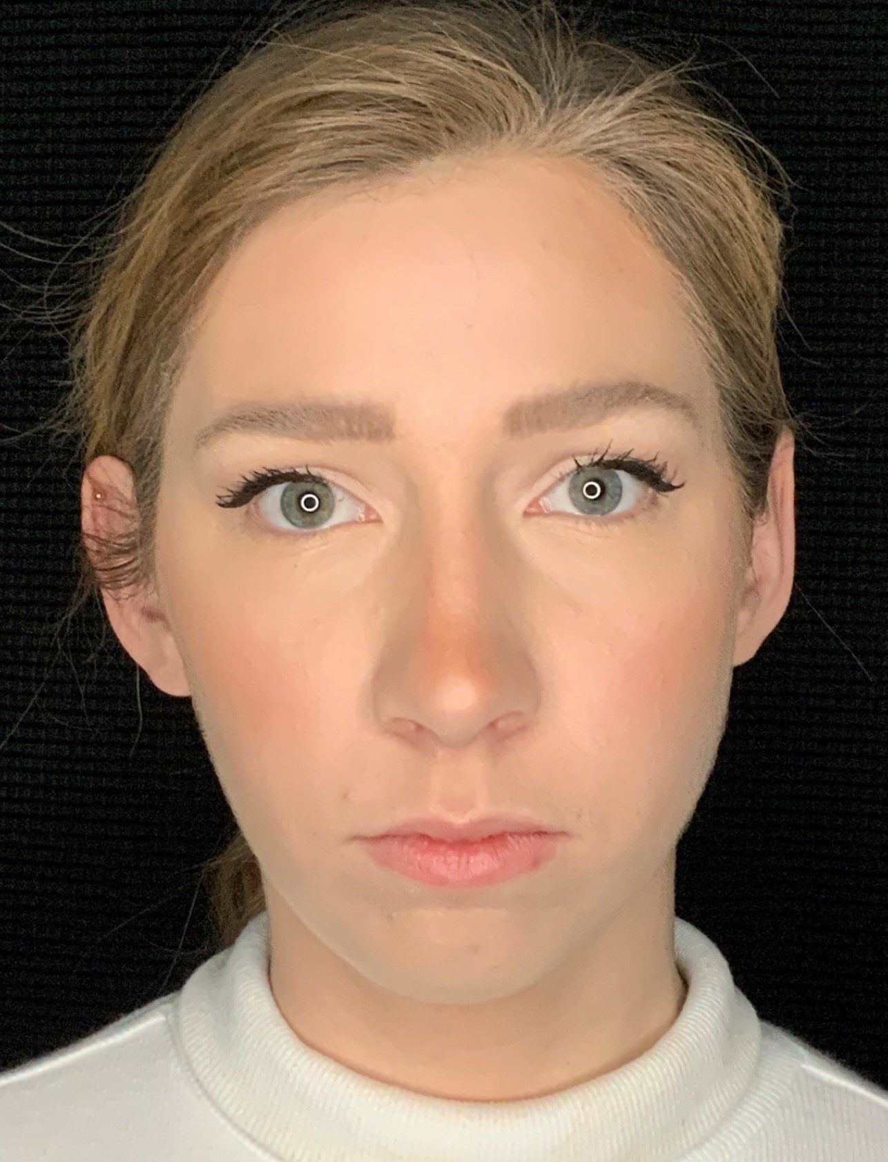 Patient #79302: Chin Augmentation Before Image