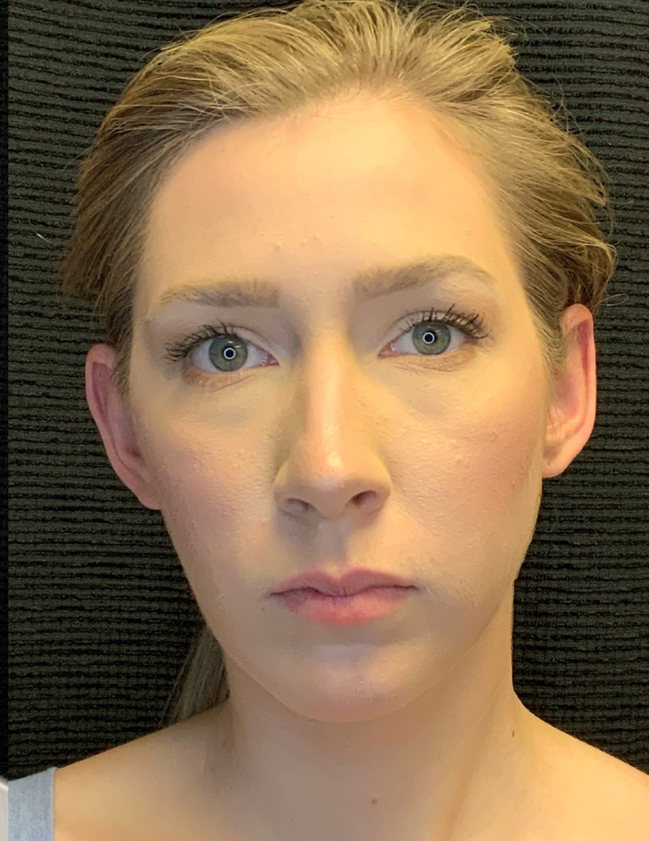 Patient #79302: Chin Augmentation After Image