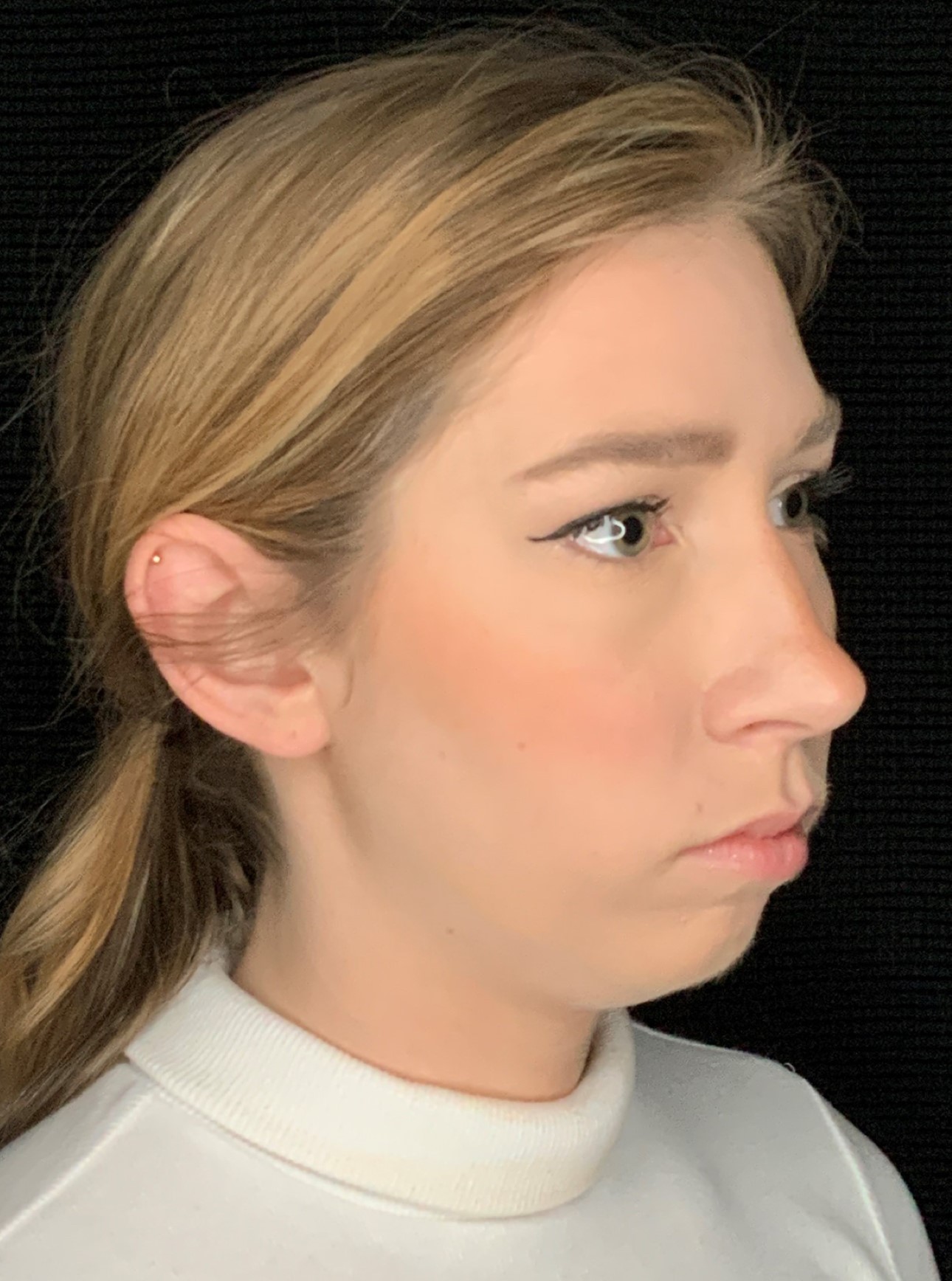 Patient #79302: Chin Augmentation Before Image