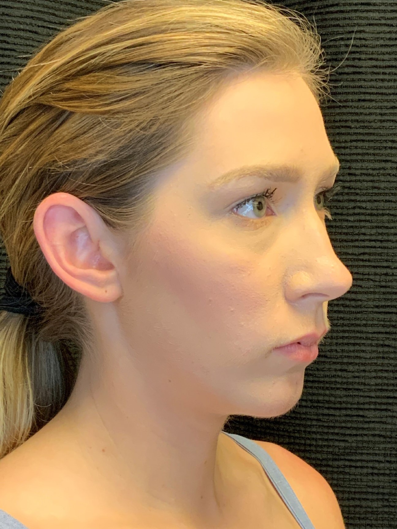 Patient #79302: Chin Augmentation After Image