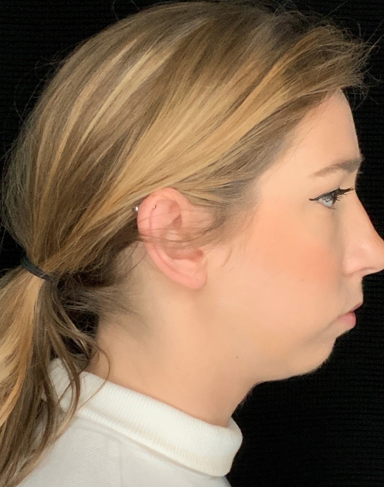 Patient #79302: Chin Augmentation Before Image