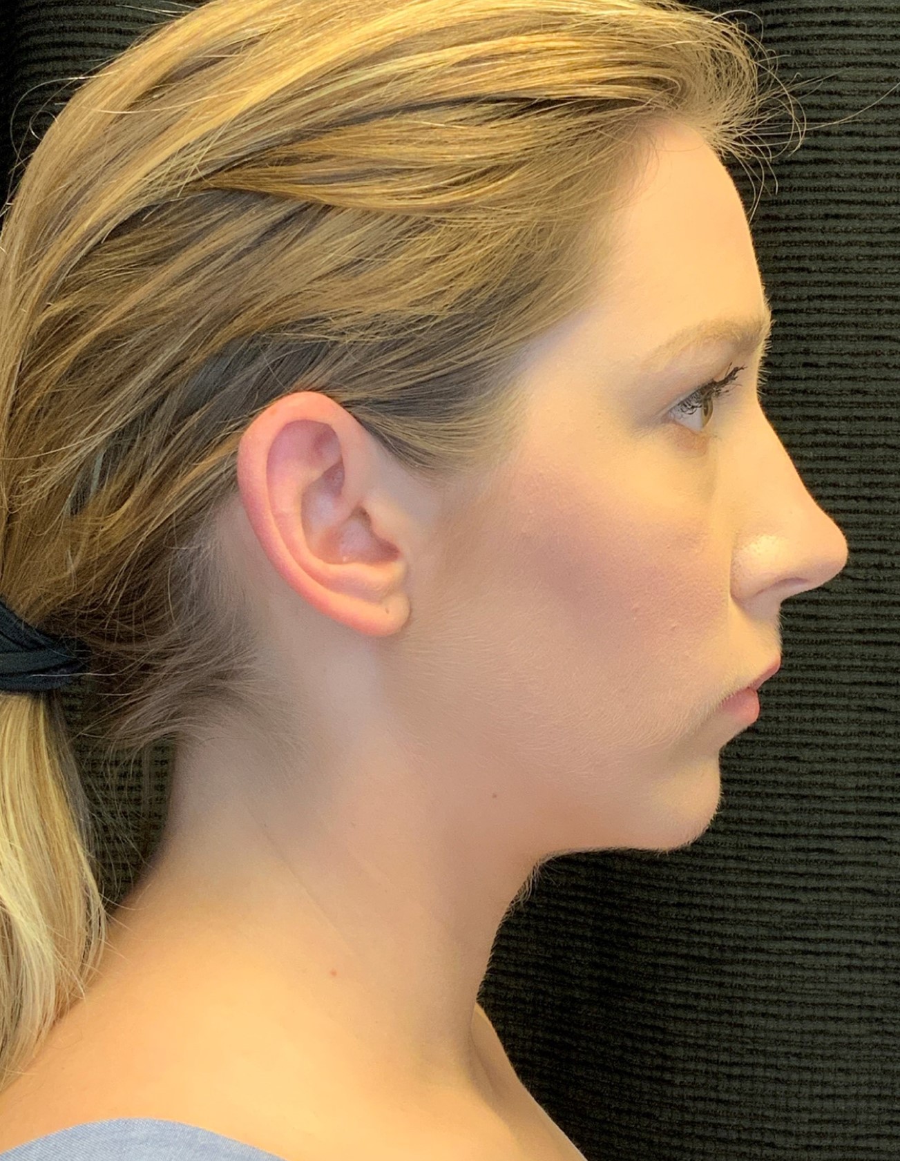 Patient #79302: Chin Augmentation After Image