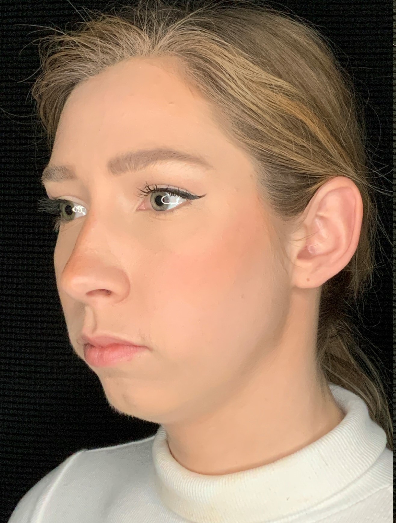 Patient #79302: Chin Augmentation Before Image