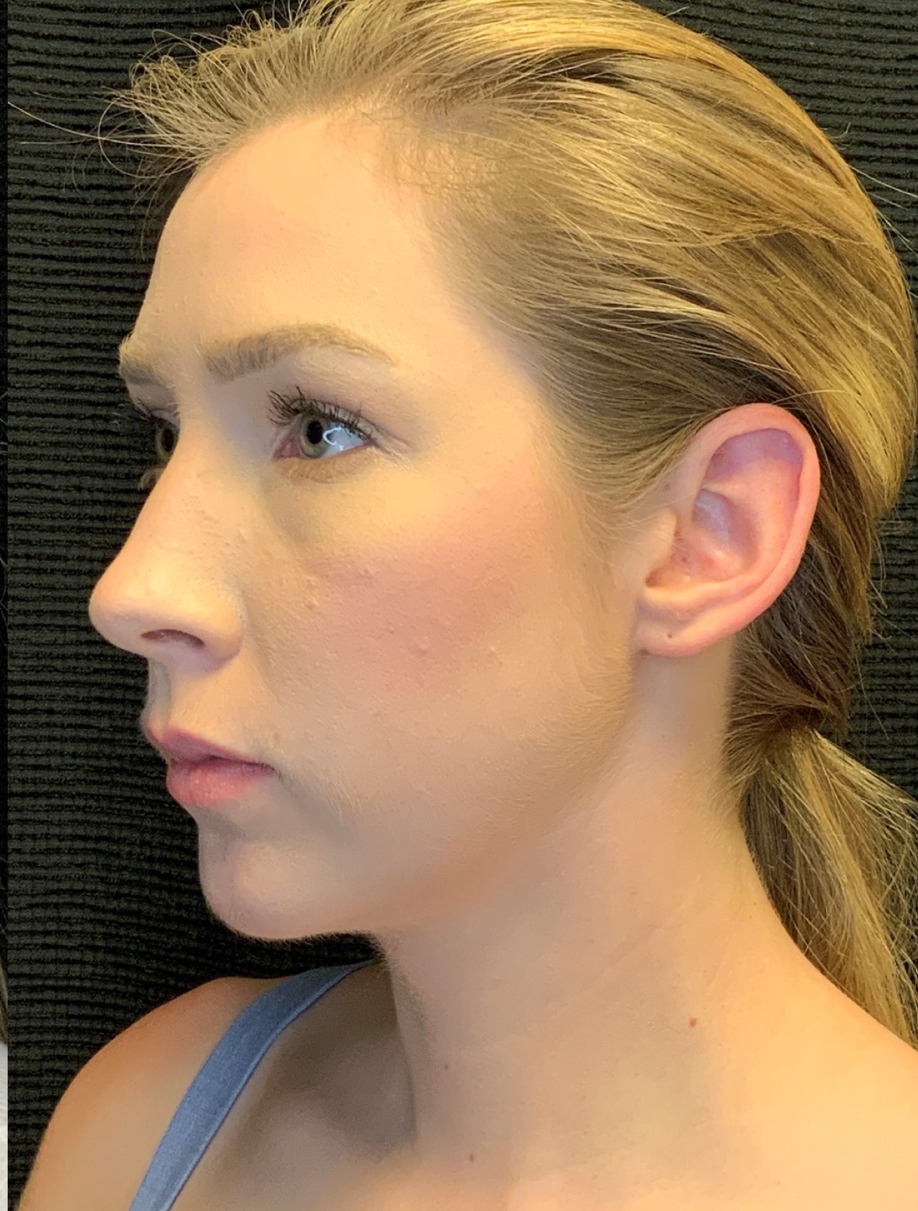 Patient #79302: Chin Augmentation After Image