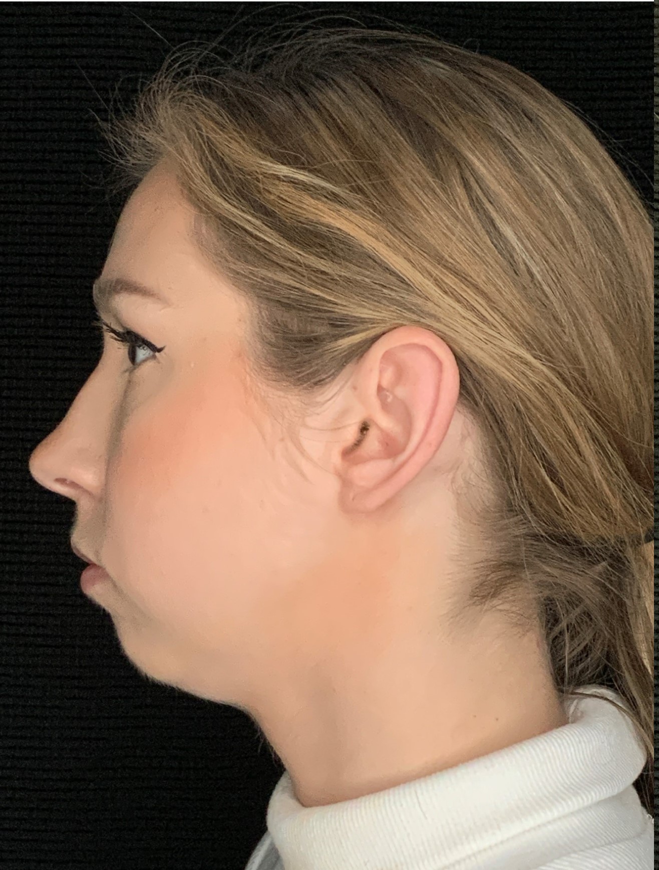 Patient #79302: Chin Augmentation Before Image