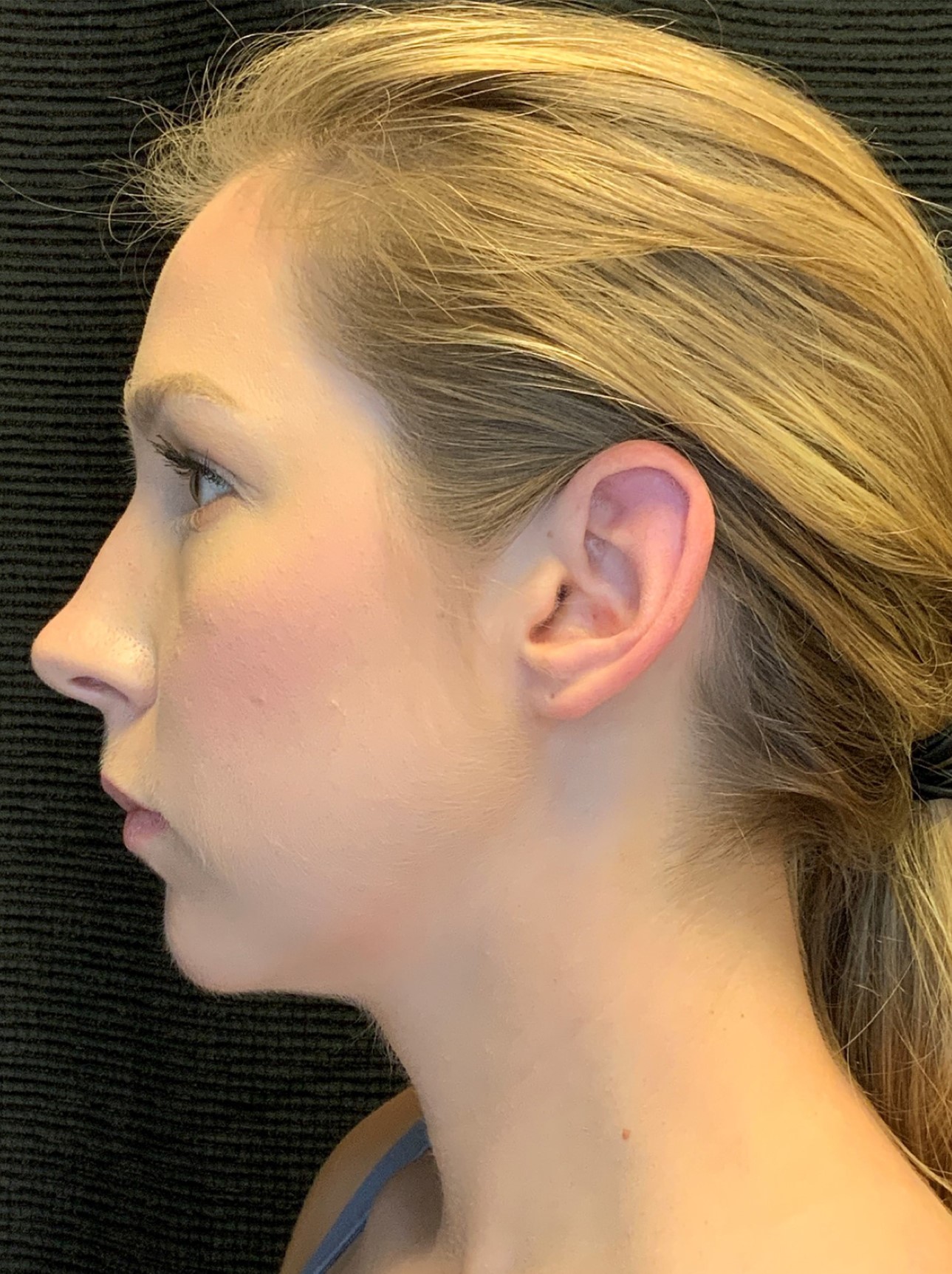 Patient #79302: Chin Augmentation After Image
