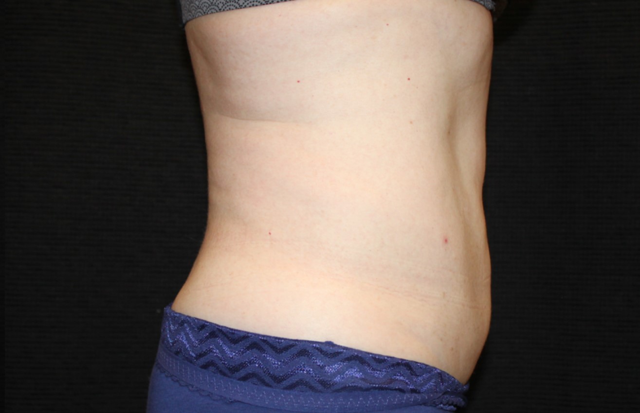 Patient #58820: CoolSculpting After Image