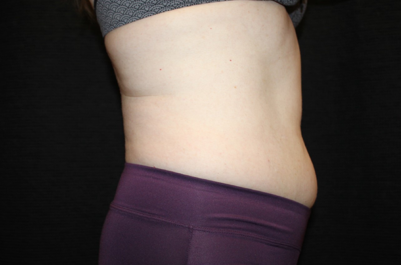 Patient #58820: CoolSculpting Before Image