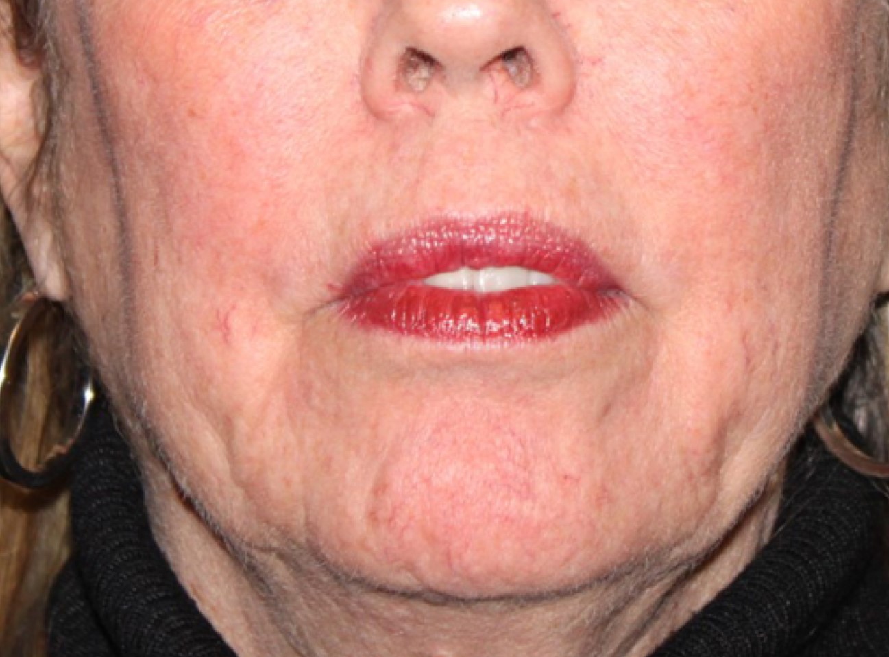 Patient #41272: Juvéderm Ultra Plus After Image