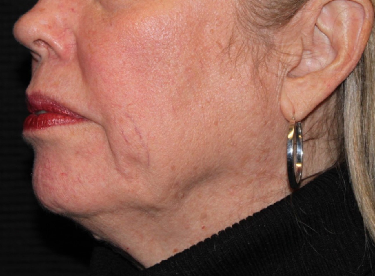 Patient #41272: Juvéderm Ultra Plus After Image