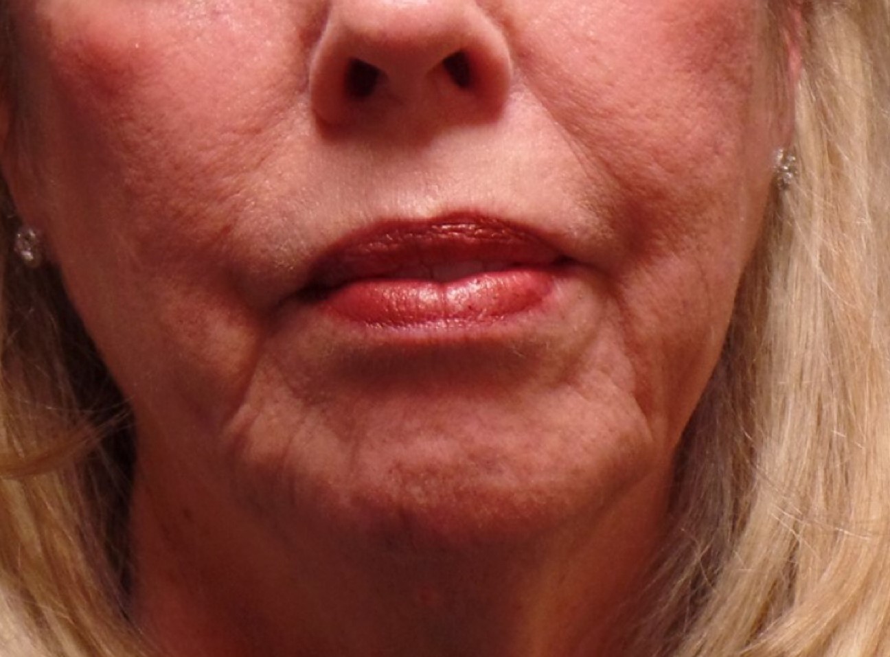 Patient #41272: Juvéderm Ultra Plus Before Image