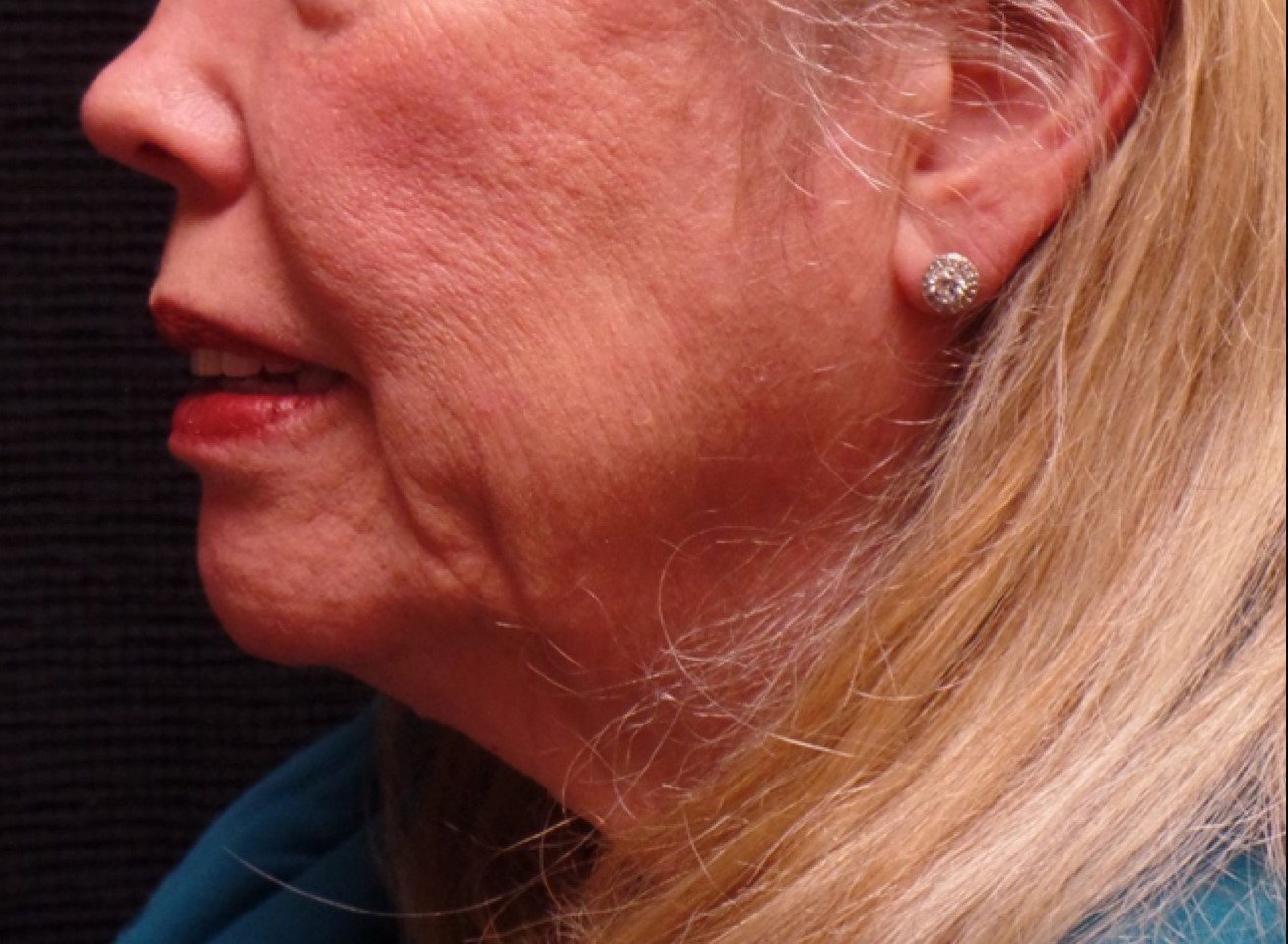 Patient #41272: Juvéderm Ultra Plus Before Image
