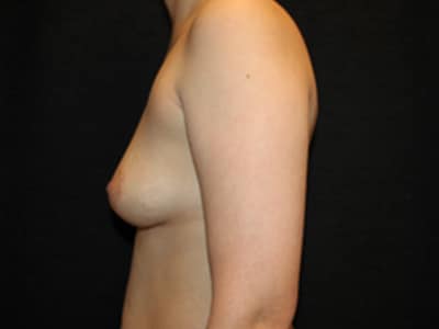 Patient #08302: Breast Augmentation Before Image
