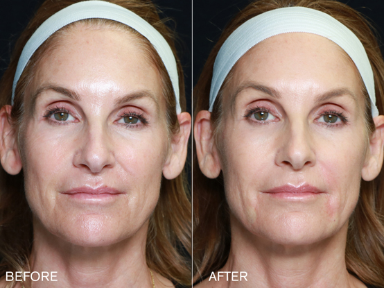 Patient #6: Renuva Fat Stimulation Combine Image