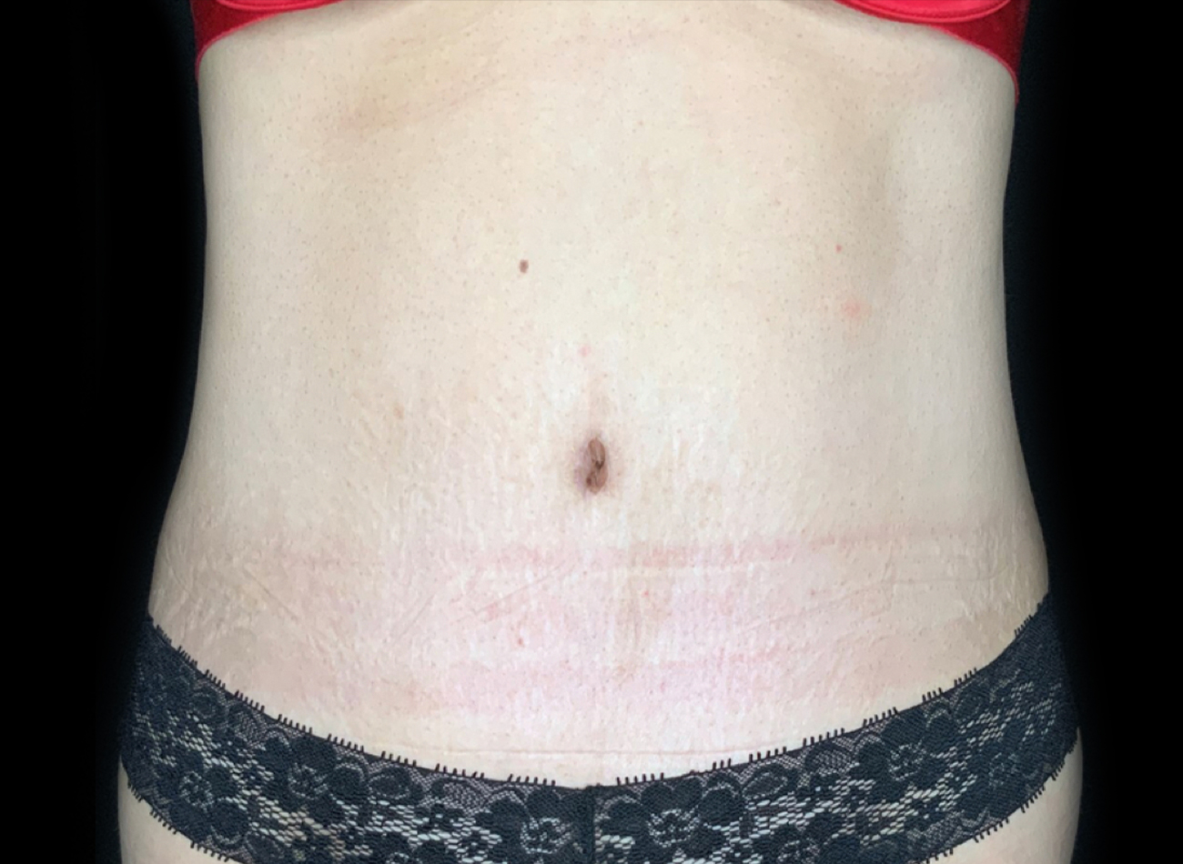 Patient #61240: Tummy Tuck After Image