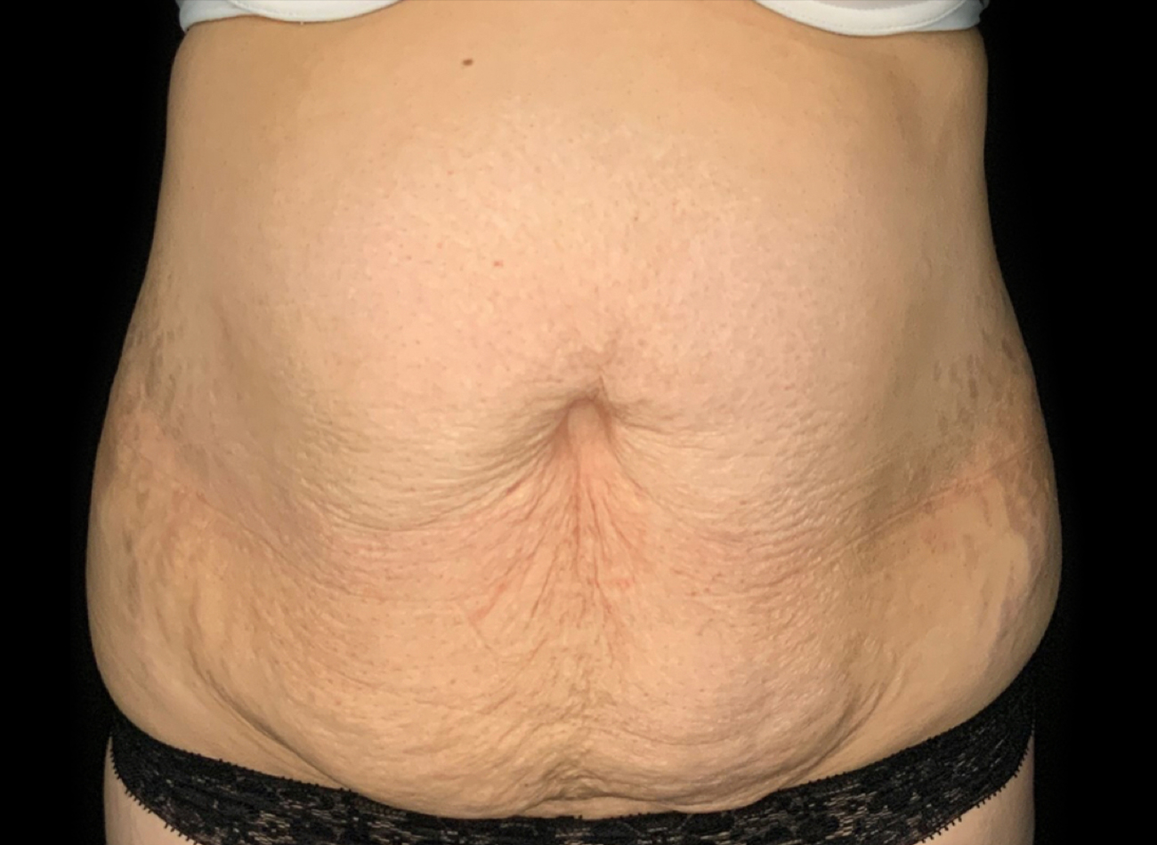 Patient #61240: Tummy Tuck Before Image