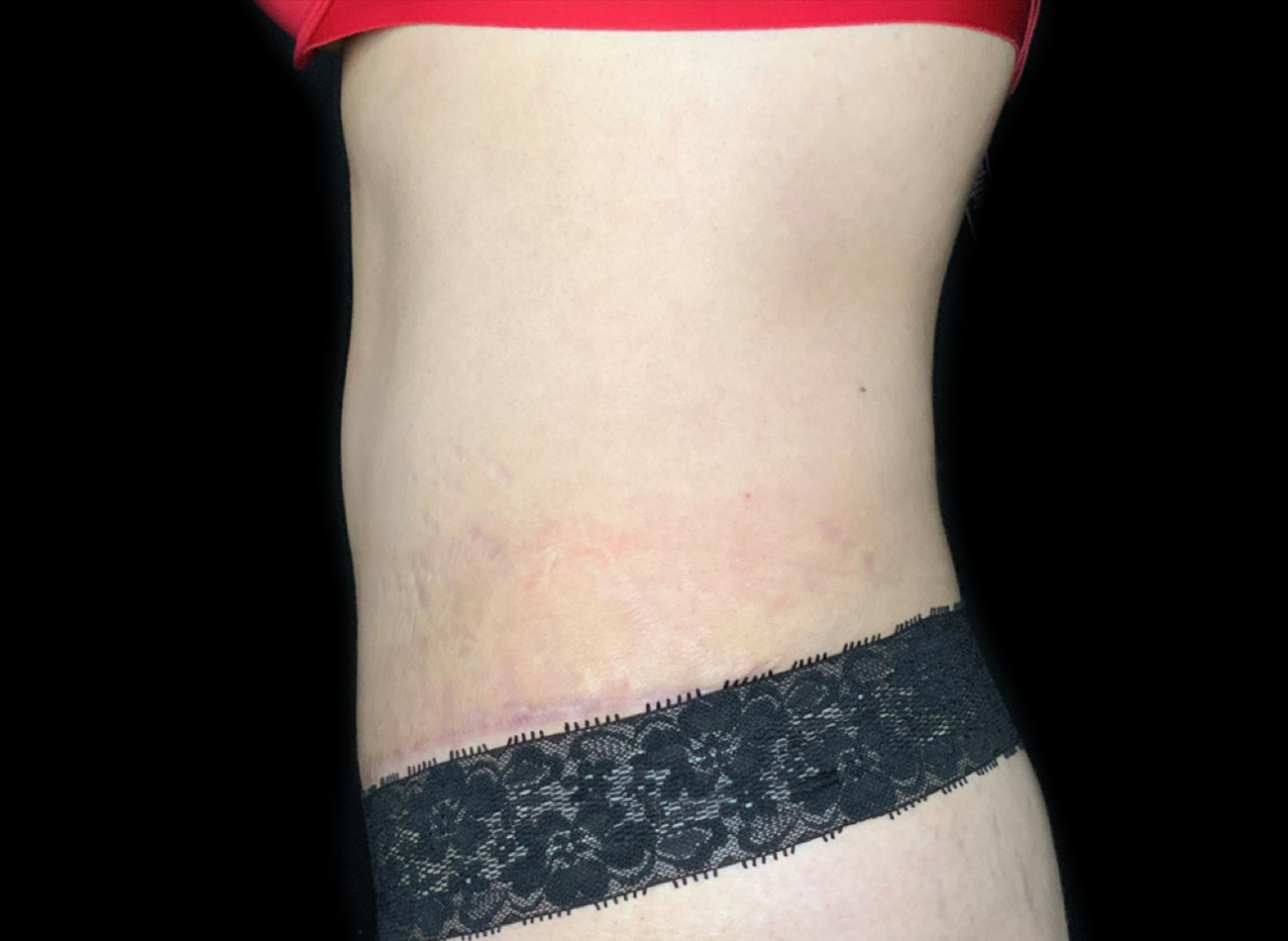 Patient #61240: Tummy Tuck After Image